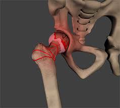 AVN treatment in Sagar