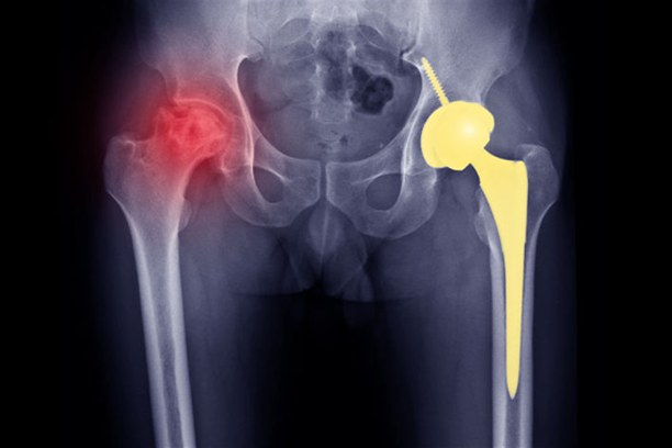 AVN treatment in Satna