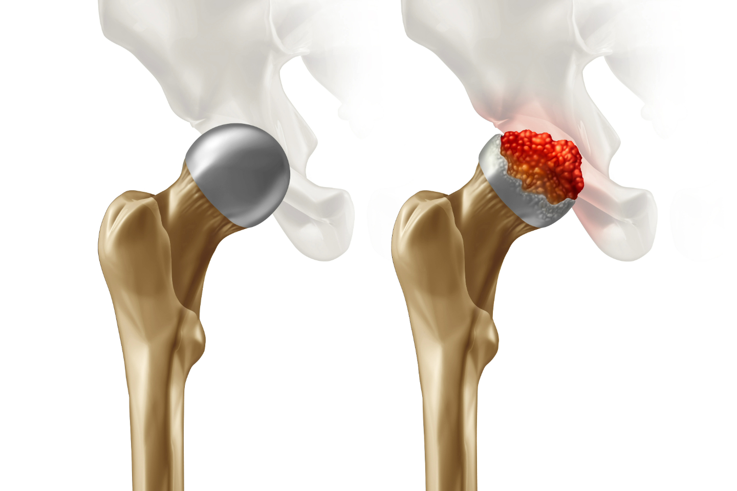 AVN treatment in Seoni