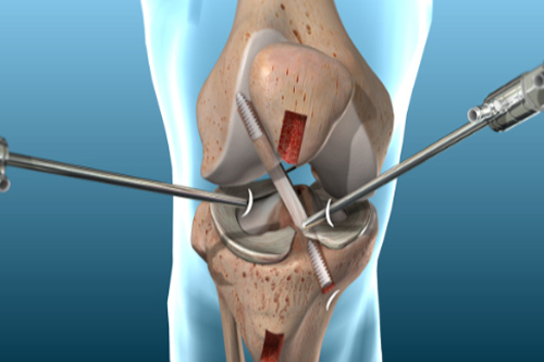 Acl ligament treatment in Jabalpur