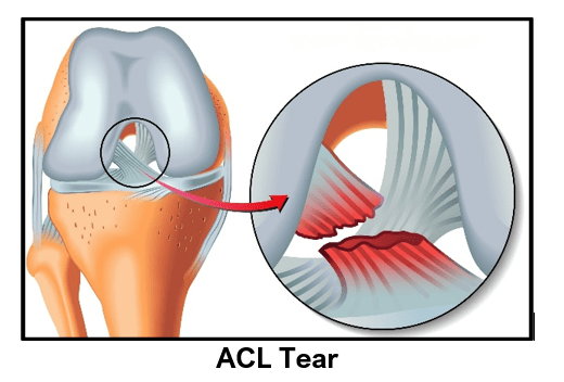 Acl ligament treatment in Mandla