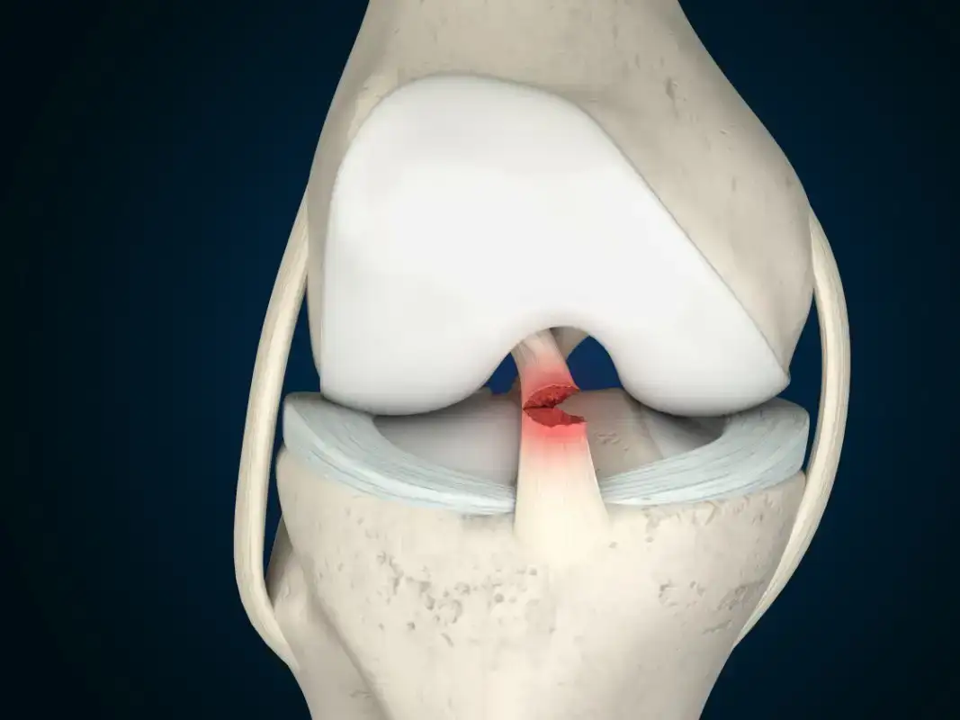 Acl ligament treatment in Satna