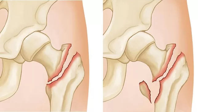 Best Joint Fracture In Nagpur