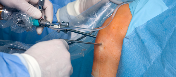 Best Knee Arthroscopy In Nagpur