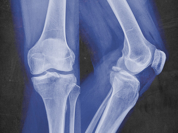Best Knee Fracture In Nagpur