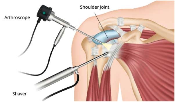 Best Shoulder Arthroscopy In Nagpur