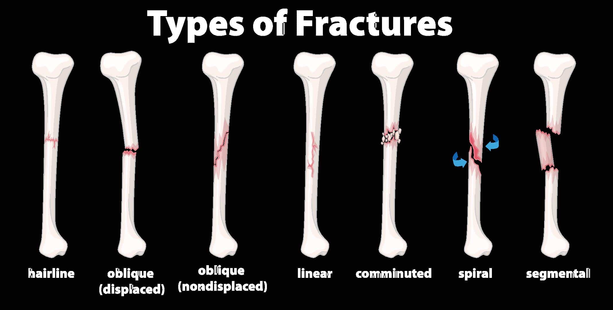 Fracture