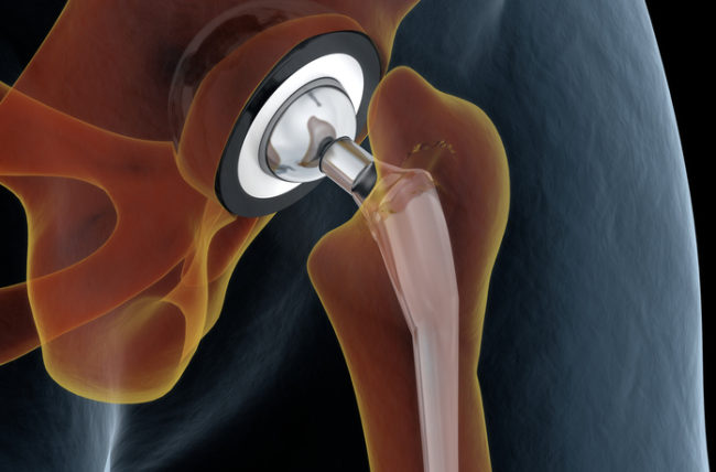 Hip Replacement Surgery In Nagpur