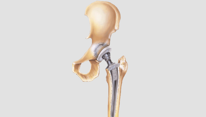 Hip replacement in Chhindwara