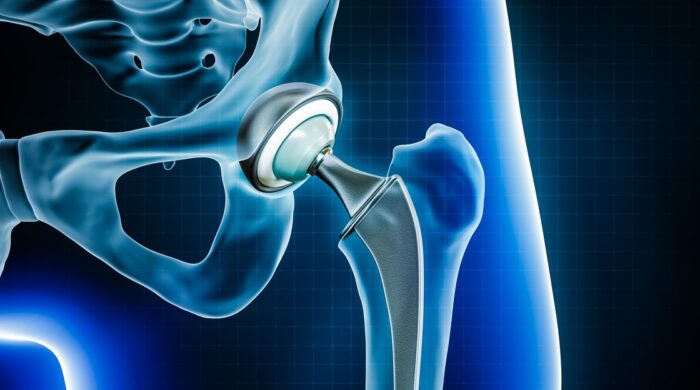 Hip replacement in Gadchiroli