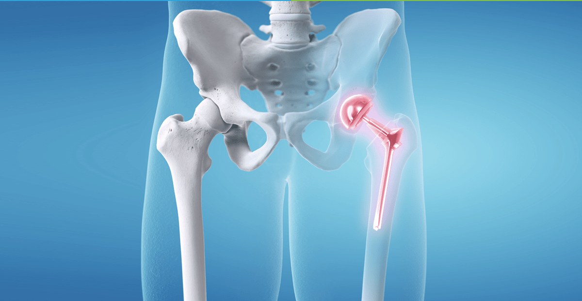 Hip replacement in Harda