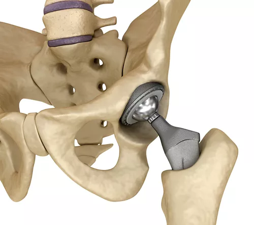 Hip replacement in Hoshangabad
