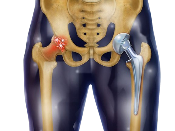 Hip replacement in Itarsi