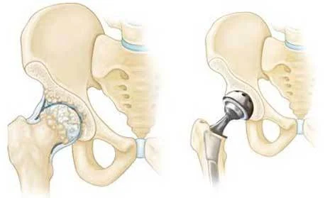 Hip replacement in Jabalpur