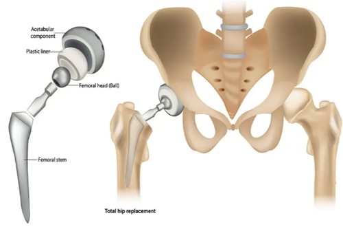 Hip replacement in Mandla