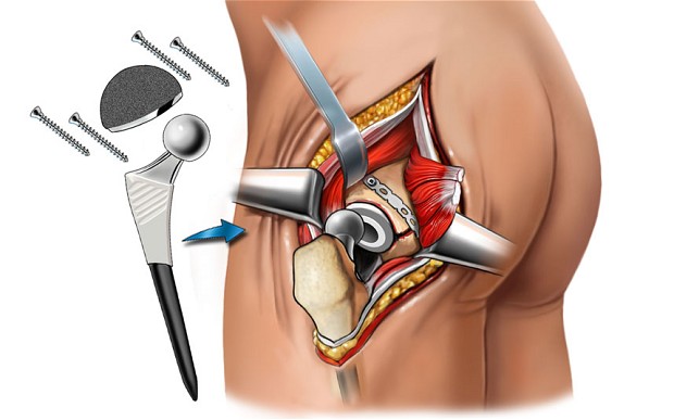 Hip replacement in Rewa