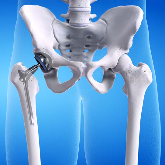 Hip replacement