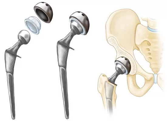 Hip replacement in Seoni