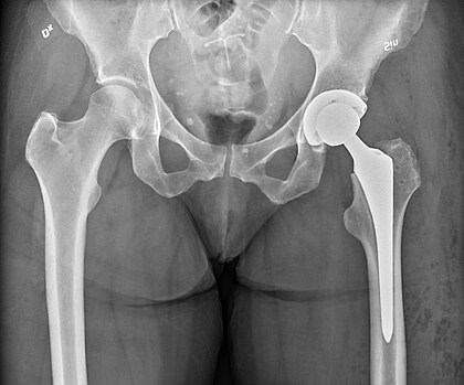 Hip replacement in Shahdol
