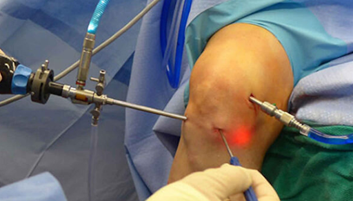 Knee Arthroscopy Surgery In Nagpur