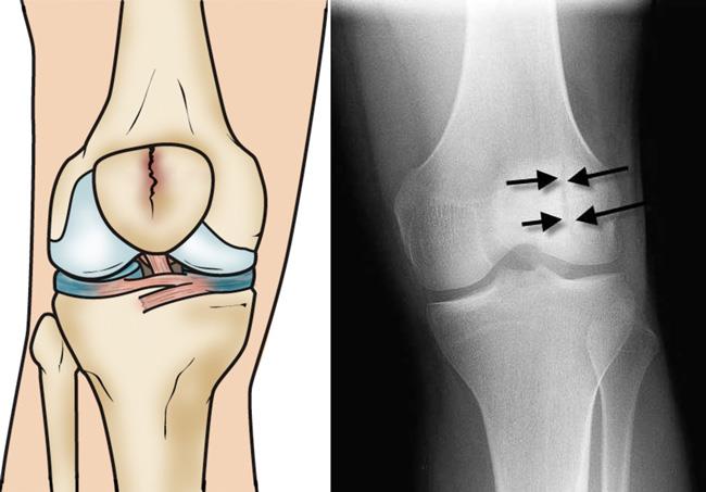 Knee Fracture Surgery In Nagpur