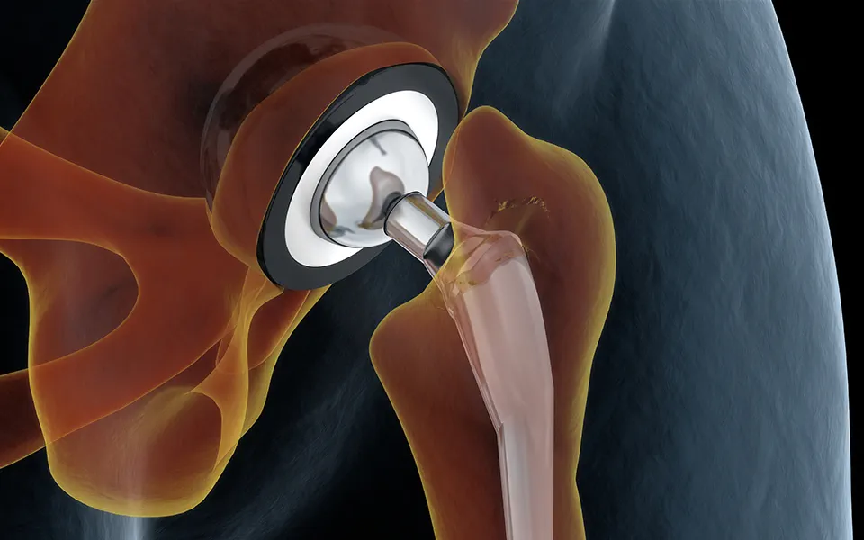 Knee/Hip Replacement