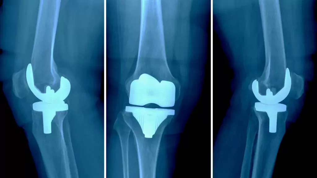 Knee Joint Preservation In Nagpur