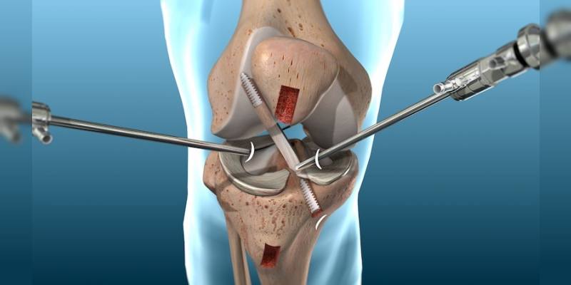 Knee Joint Preservation Surgery In Nagpur