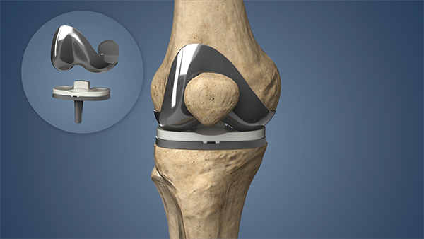 Knee Replacement In Adilabad