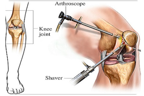 Knee Replacement In Chhindwara