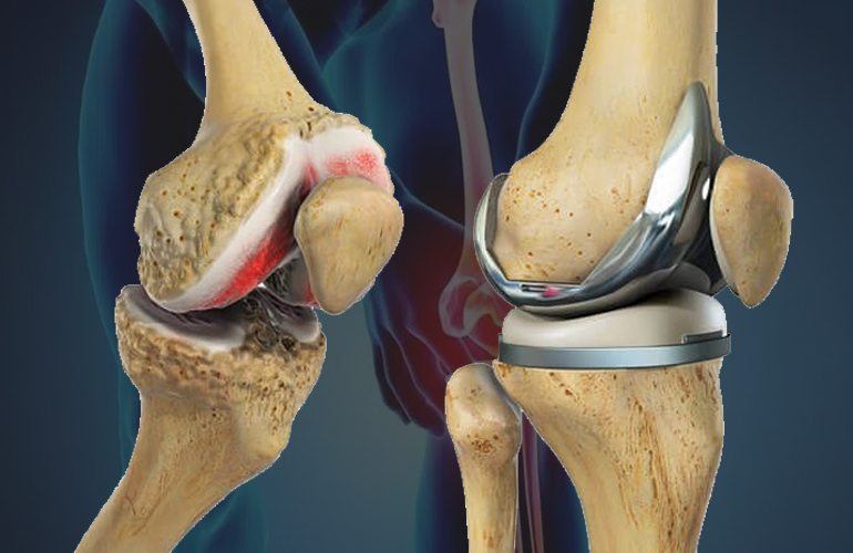 Knee Replacement In Katni