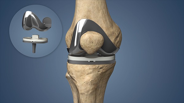 Knee Replacement In Rewa