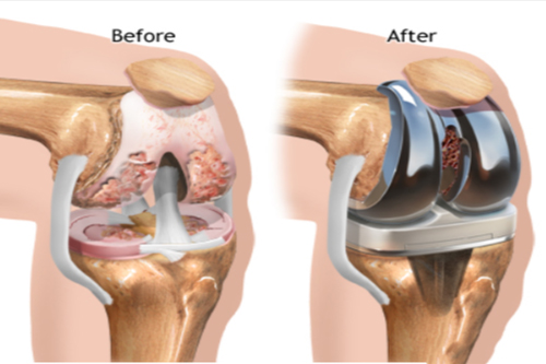 Knee Replacement In Sagar