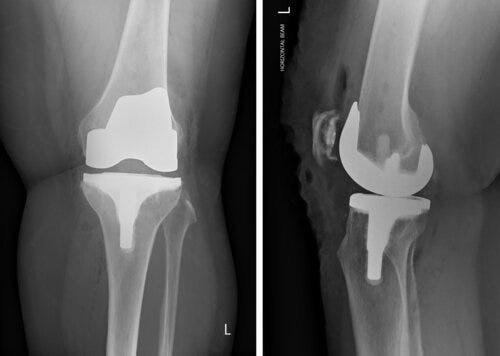 Knee Replacement In Satna