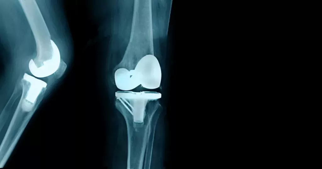 Knee Replacement In Yavatmal