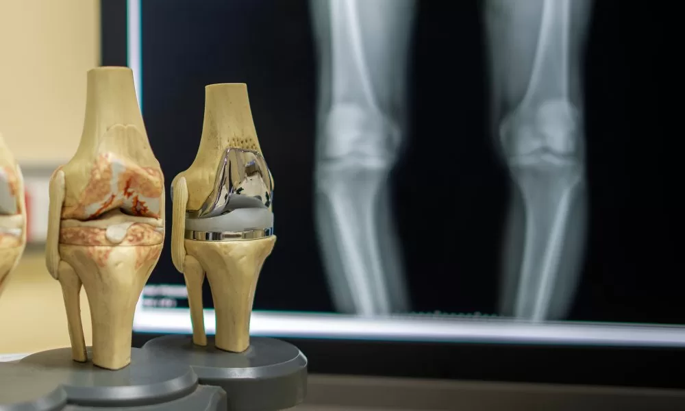 Knee Replacement Surgery In Nagpur