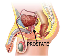 Prostate & Stone Surgery