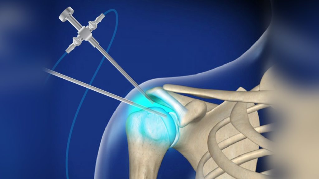 Shoulder Arthroscopy In Nagpur
