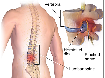 Spine Surgery